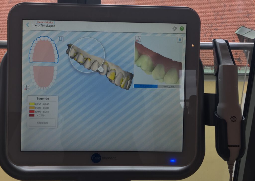 iTero Intraoralscanner für den digitalen Zahnabdruck