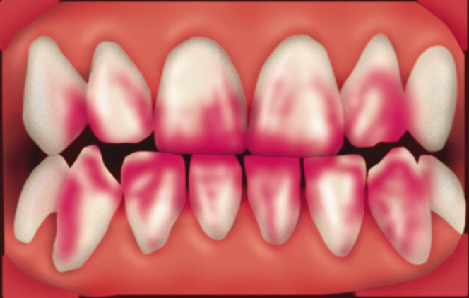 Illustration: Zähne mit rot angefärbten bakteriellen Belägen (Plaque-Anfärbung)